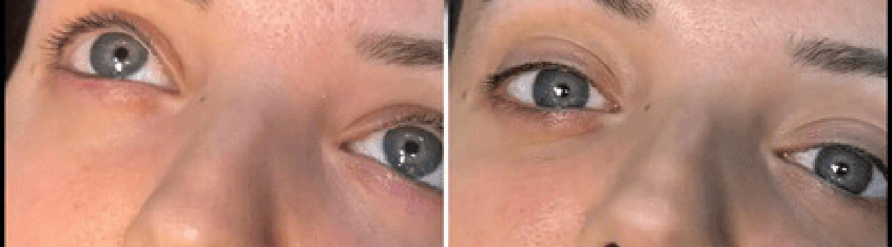 Dermal Fillers